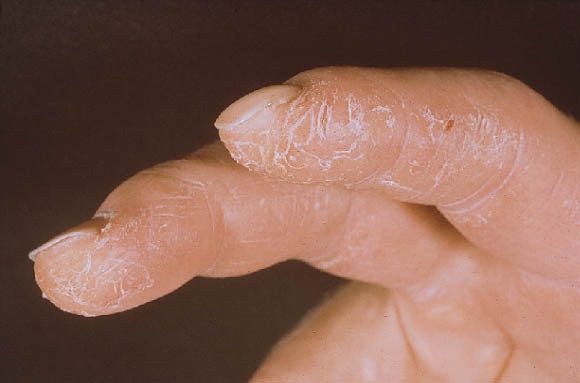 Hogyan szabaduljunk meg az ujjvégek hámlásától?