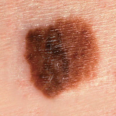 A vörösborban található rezveratrol gátolja a melanoma kialakulását?