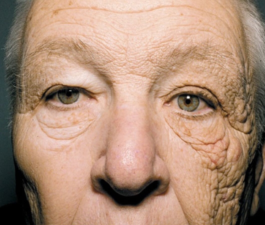 Ráncok, akné és terhességi csíkok