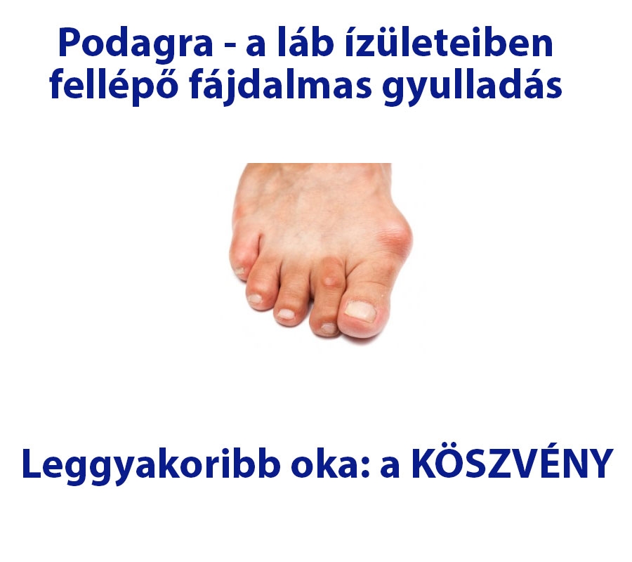 Podagra - a láb ízületeiben fellépő fájdalmas gyulladás
