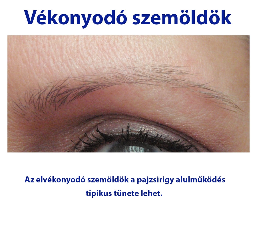 Vékonyodó szemöldök