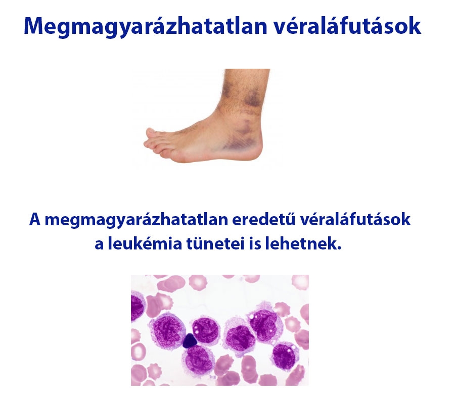 Megmagyarázhatatlan véraláfutások