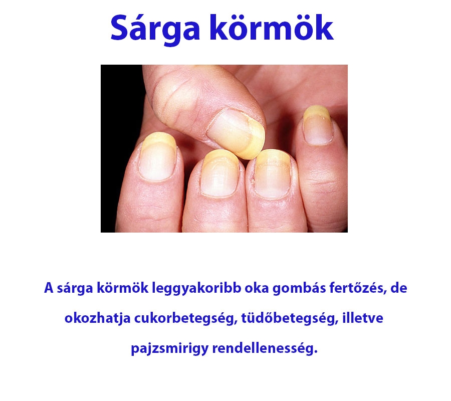 Sárga körmök