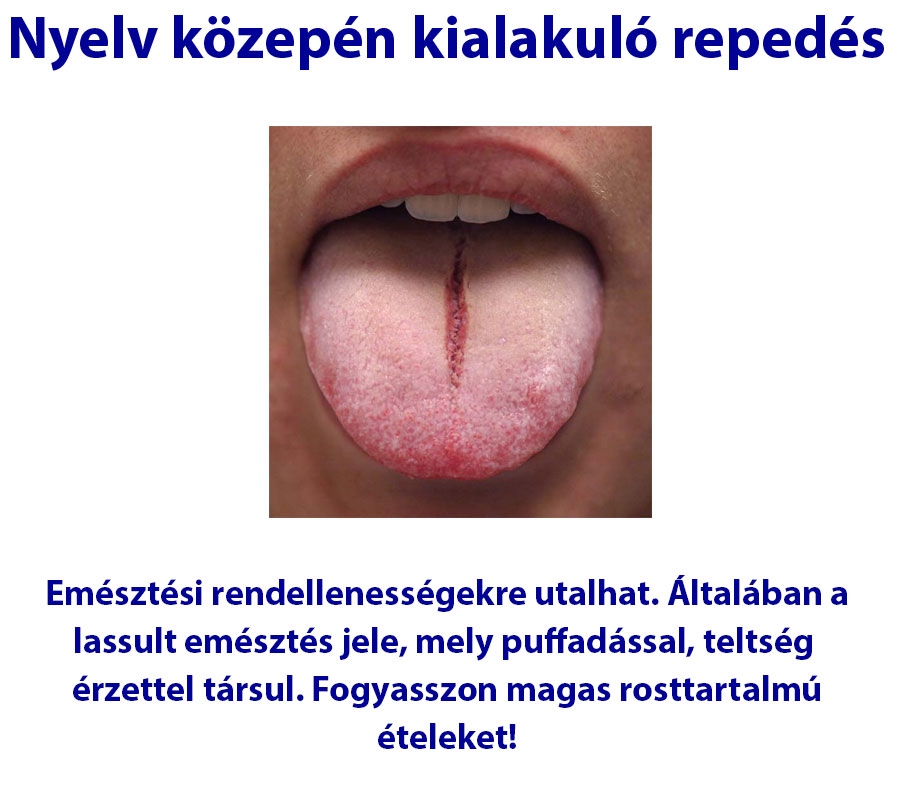 Nyelv közepén kialakuló repedés