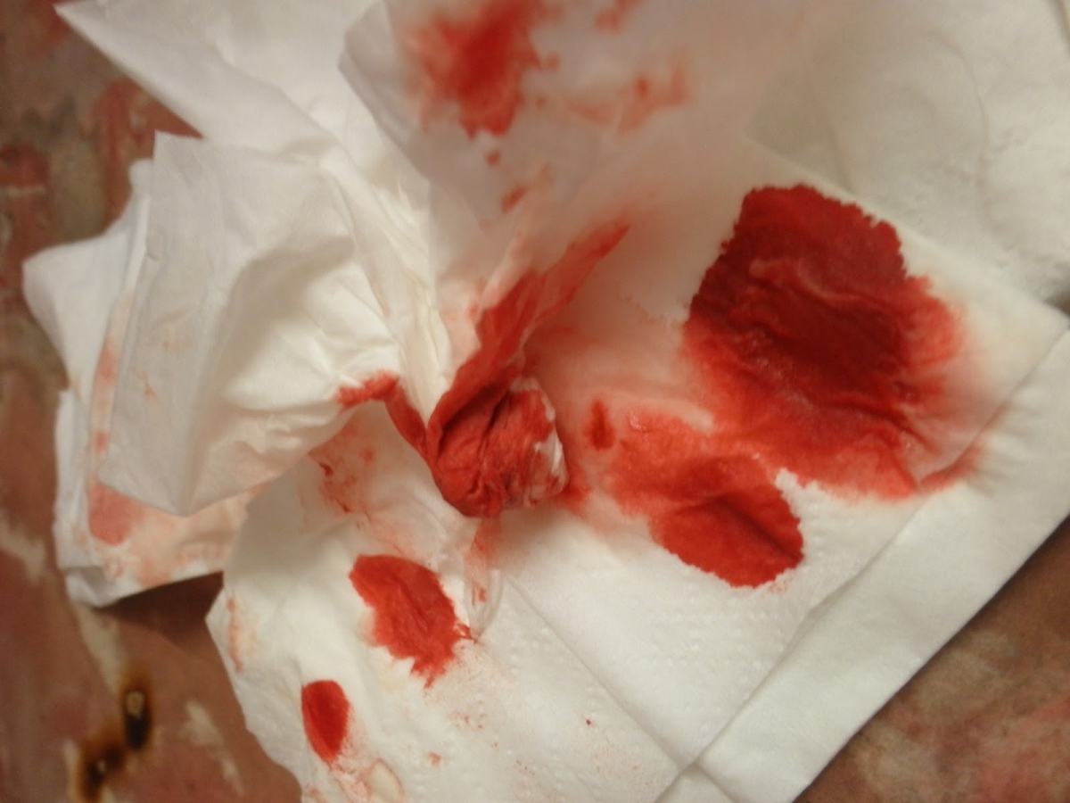 10 otthon végezhető kezelés az orrvérzés ellen