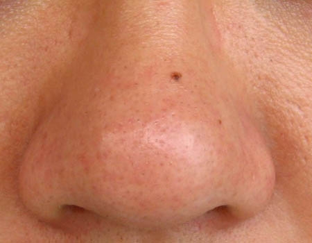 18 otthoni praktika a mitesszerek ellen