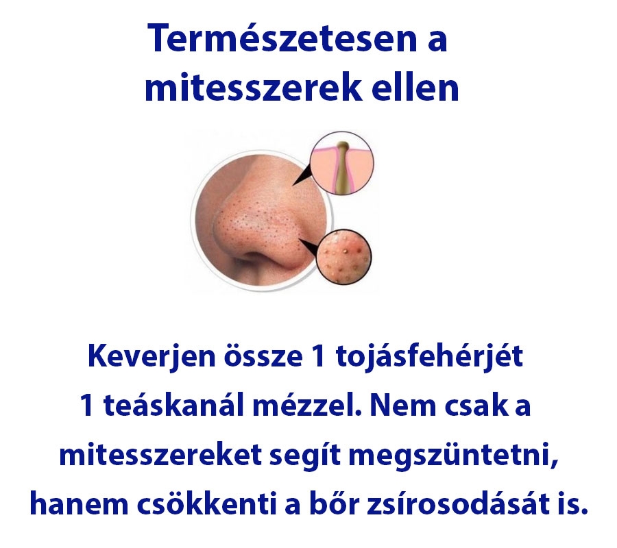 Házi praktika mitesszerek ellen