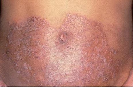 Hogyan szabaduljunk meg a (Tinea Cruris) gombás fertőzéstől?