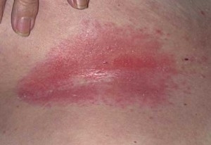 Hogyan szabaduljunk meg a mell alatti kiütésektől?