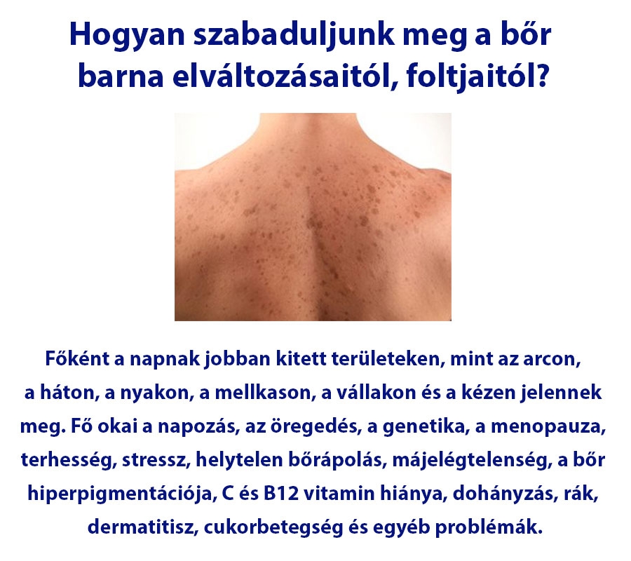 Hogyan szabaduljunk meg a bőr barna elváltozásaitól, foltjaitól?