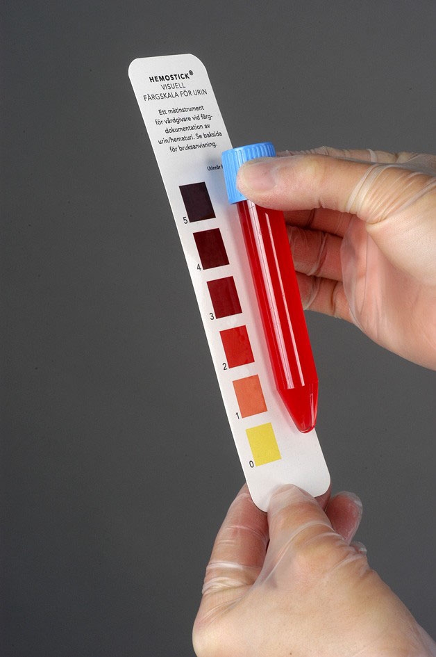 Ha vér van a vizeletben