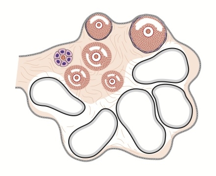 A policisztás ovárium szindróma (POS)