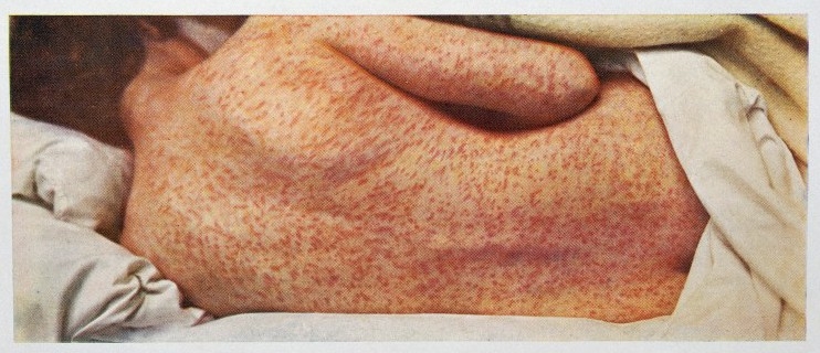 A kanyaró gyógyítása otthon