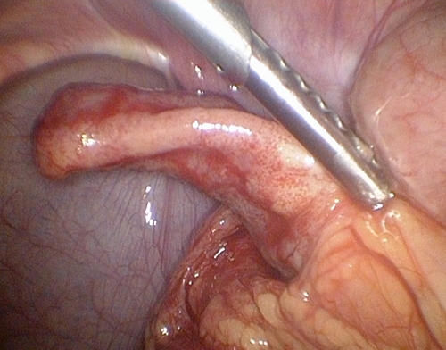 A vakbélgyulladás figyelmeztető jelei gyerekeknél