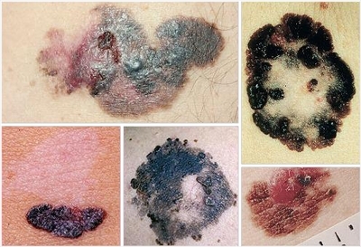 A vírusok és a rák