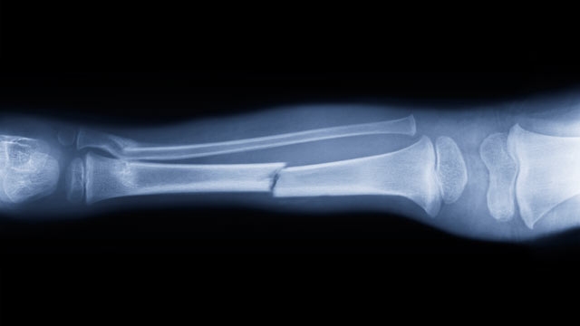 A kalcium egészségre gyakorolt jótékony hatása