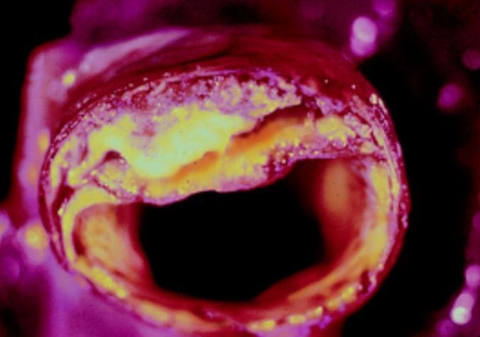 A legjobb artéria tisztító szuper táplálékok