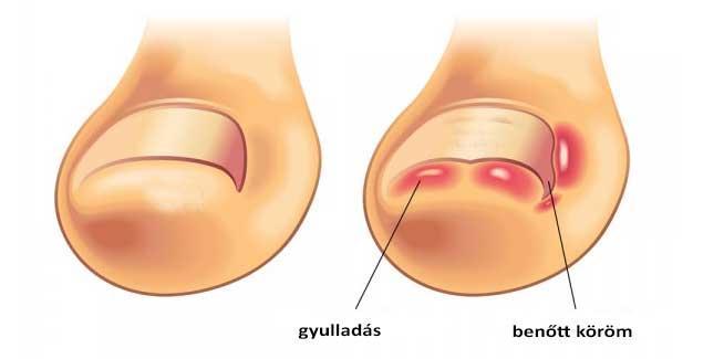 Hogyan kezeljük otthon a benőtt körmöt?