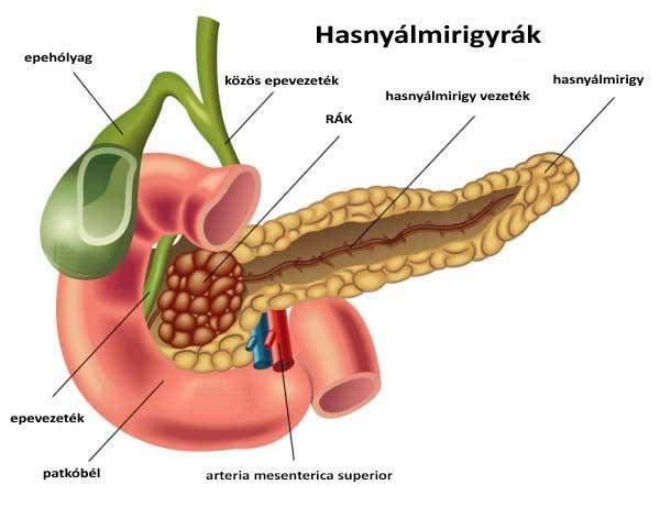 A hasnyálmirigyrák 10 figyelmeztető jele, amit nem szabad figyelmen kívül hagyni