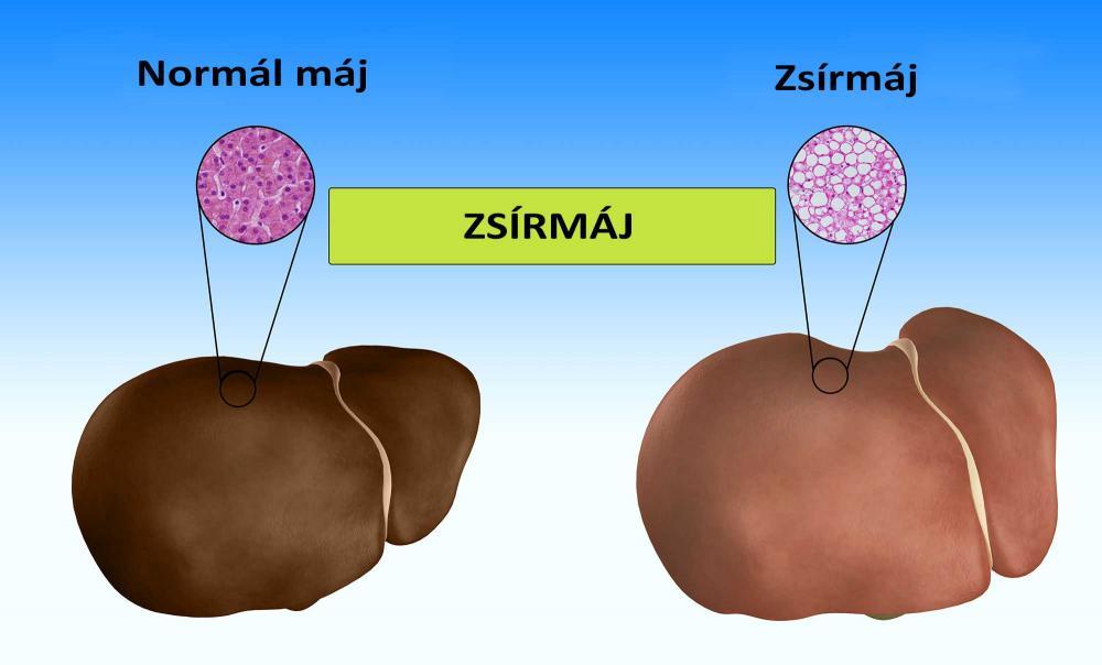 Természetes gyógymód zsírmáj esetén