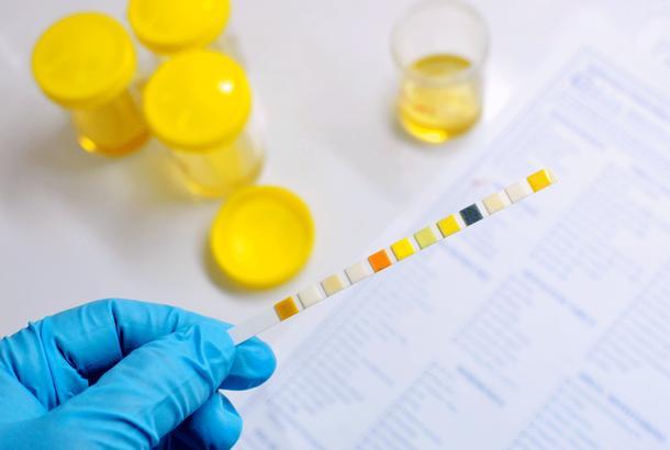 Megváltozott vizelet? Ezekre figyeljen oda!