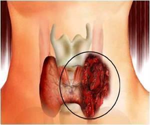 Amit a Hashimoto thyreoiditisről mindenképp tudnia kell