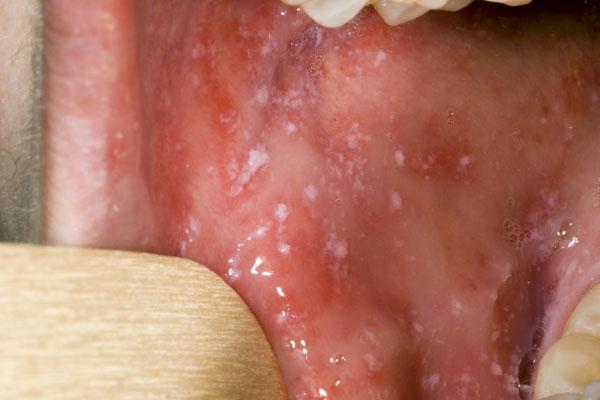 Fontos információk a kanyaróról, amit mindenkinek ismernie kell