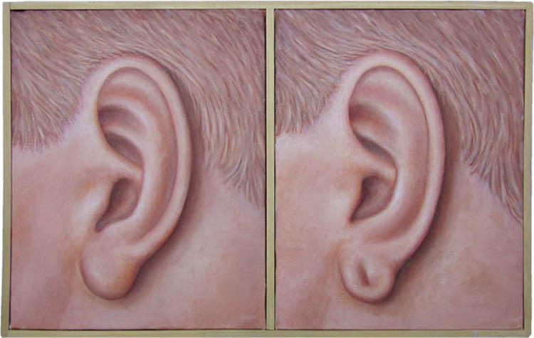 Fülcimpa ráncosodása: súlyos betegség állhat a háttérben?