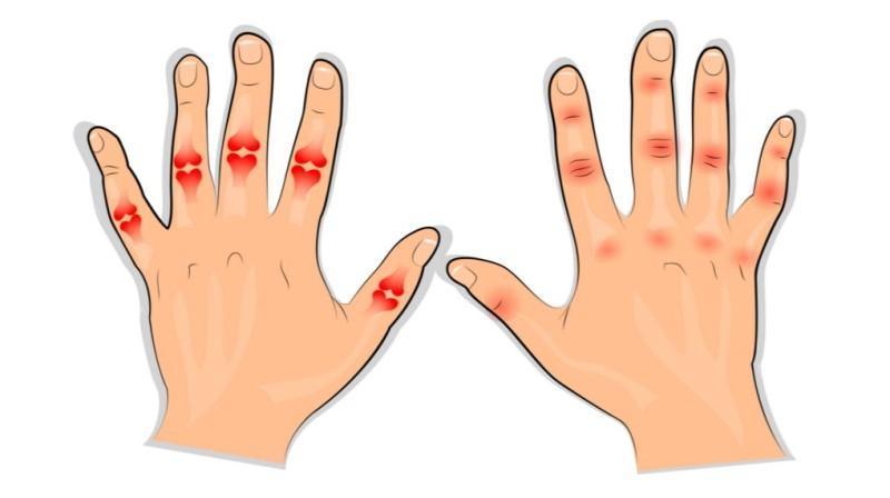 Milyen ételeket kerüljön ízületi gyulladás esetén?