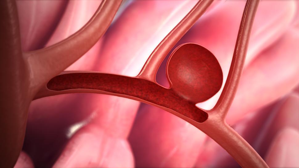 Ismerje fel még időben az agyi aneurizma tüneteit!