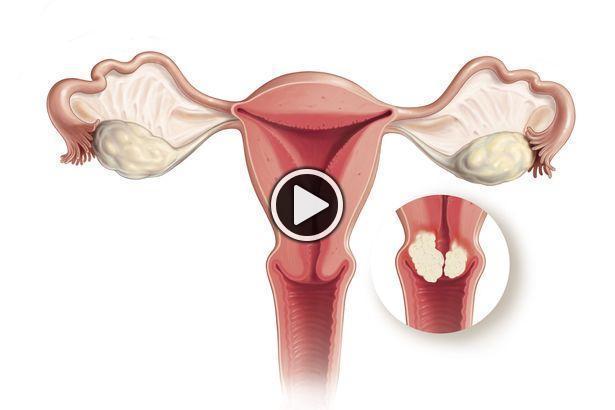 A méhnyakrák korai tünetei