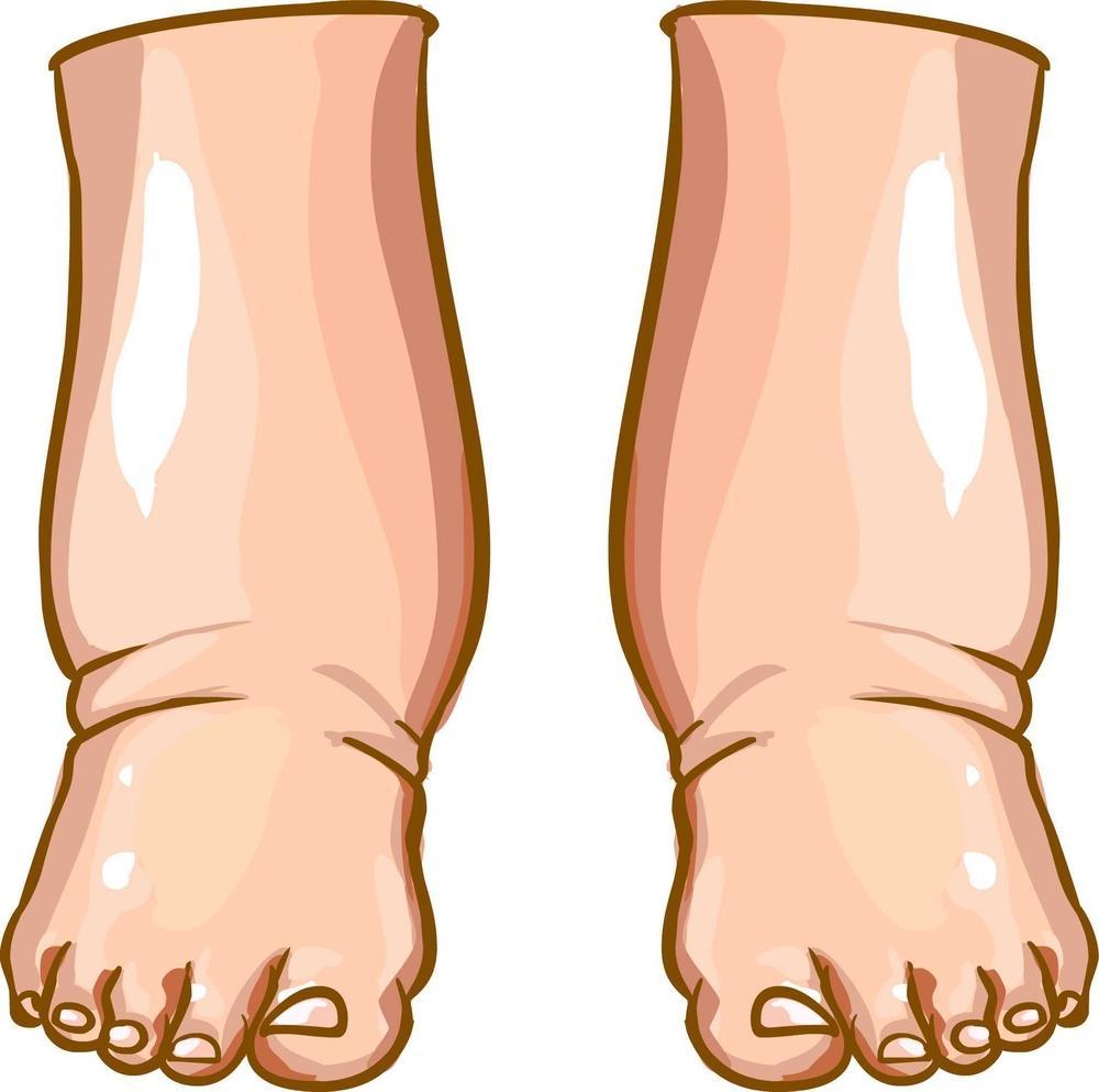 Lábdagadás, ödéma