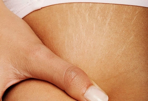 A striák megelőzése, gyógymódja, és eltűntetése