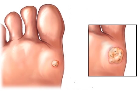 Otthoni gyógymódok a tyúkszem gyógyítására