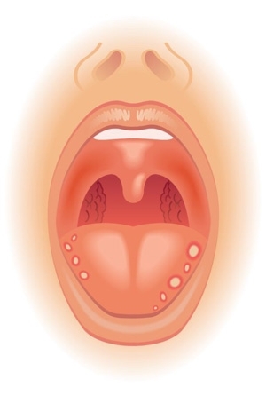 Otthoni gyógymódok a nyelven kialakuló hólyagok kezelésére