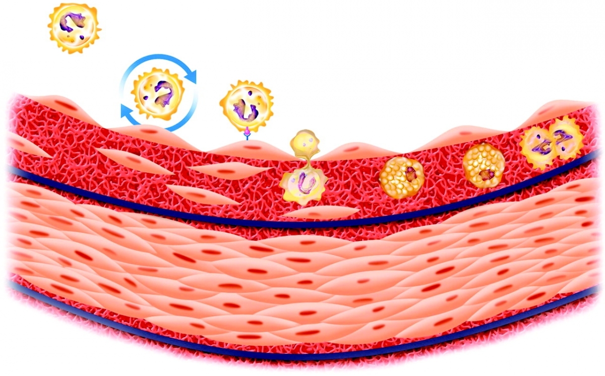 Az érelzáródás otthoni gyógyítása
