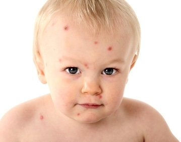 A bárányhimlő és a védőoltás