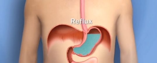 Torokfájás és savas reflux