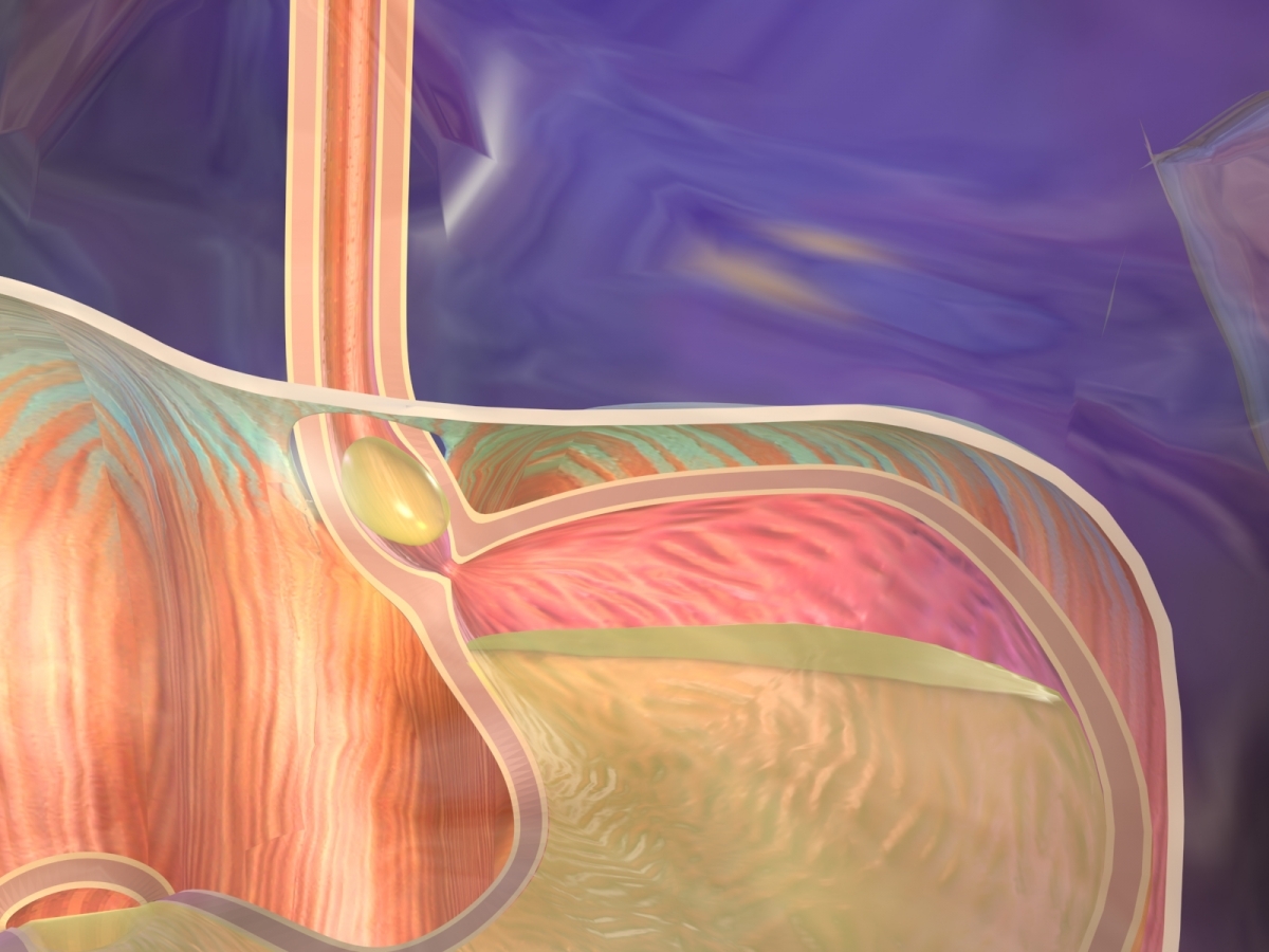 Hogyan kerülje el a savas reflux és a gyomorégés kialakulását