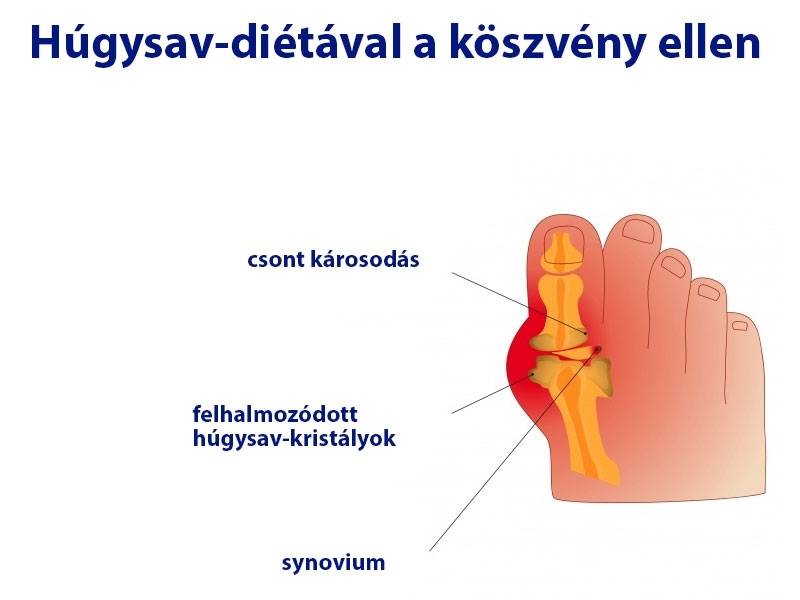 A köszvény betegség háttere